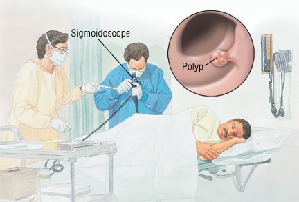 Sigmoidoscopy Guide | Drugs.com