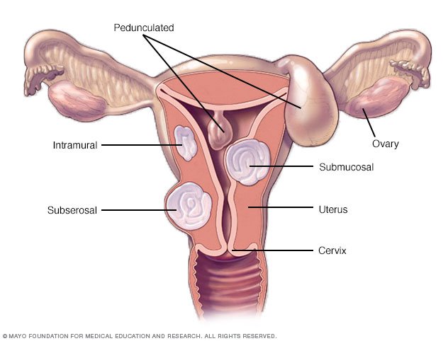 cancer cervix factores riesgo