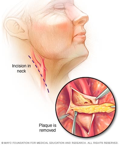 sinus drainage surgical procedure