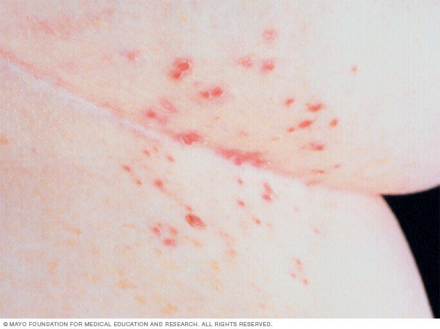 Scabies Disease Reference Guide - Drugs.com