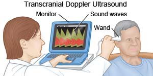 transcranial doppler technique