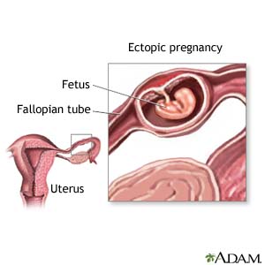 Ectopic Pregnancy Aftercare Instructions What You Need To Know