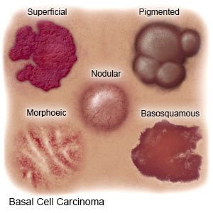 Basal Cell Carcinoma - What You Need to Know