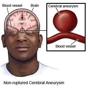 cerebral aneurysm