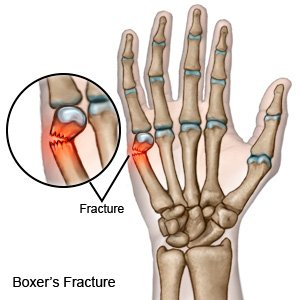 Boxer Fracture