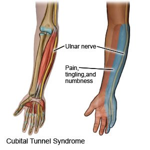 Cubital Tunnel Syndrome