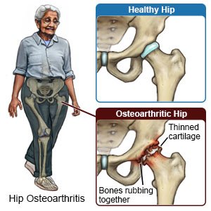 Hip Osteoarthritis