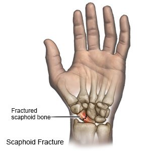 Scaphoid Fracture