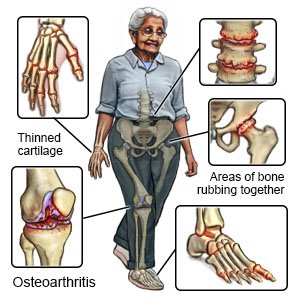 Osteoarthritis