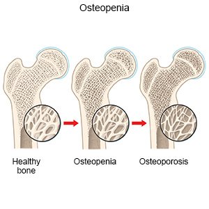 Osteopenia