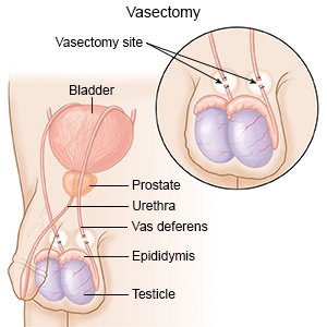 Vasectomy