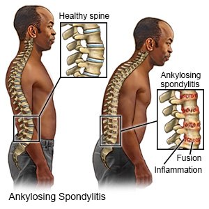 Ankylosing Spondylitis