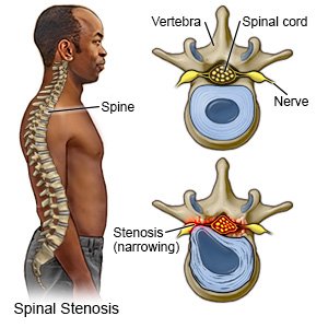 Spinal Stenosis