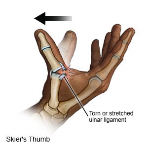 Skier's Thumb