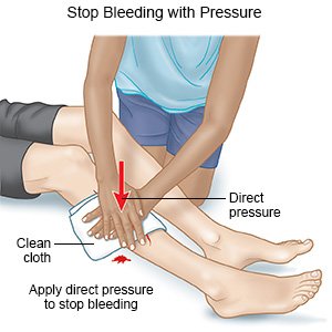 Stop Bleeding with Pressure