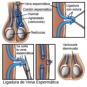 Ligadura de Vena Espermática
