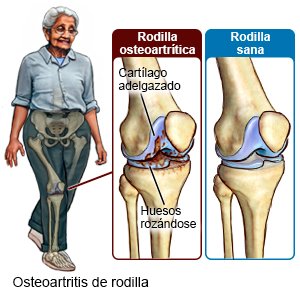 Osteoartritis de rodilla