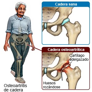 Osteoartritis de cadera