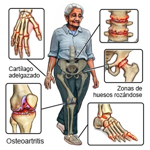 Osteoartritis