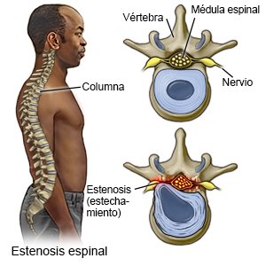 Estenosis espinal