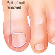 Ingrown Toenail Guide: Causes, Symptoms and Treatment Options