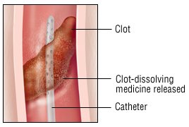 clot buster for stroke