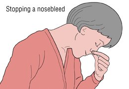 Nosebleed (Epistaxis) Guide: Causes, Symptoms and Treatment Options