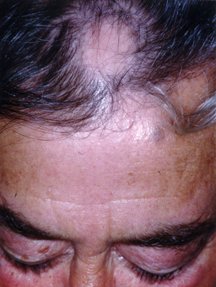 White patch of hair syndrome