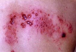 What does valtrex do for shingles zit