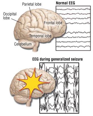 Seizures gran tramadol mal can cause