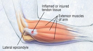 Tendonitis Guide Causes Symptoms And Treatment Options