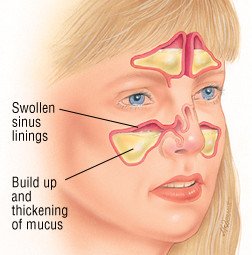 Acute Sinusitis Guide Causes Symptoms And Treatment Options