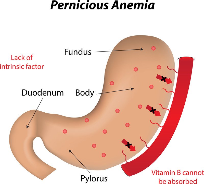 Vitamin B12 Deficiency Guide Causes Symptoms And Treatment Options