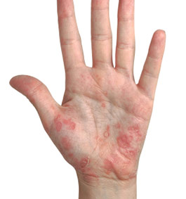 mild psoriasis on hands