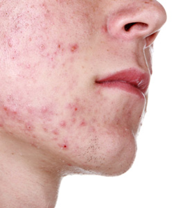 The 3 Most Common Types of Spots And What To Do About Them - PURE SKIN FOOD