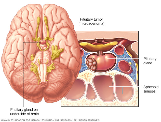 Penyebab dan gejala tumor hipofisis