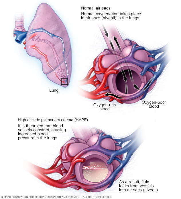 Pulmonary Edema Disease Reference Guide Drugs Com