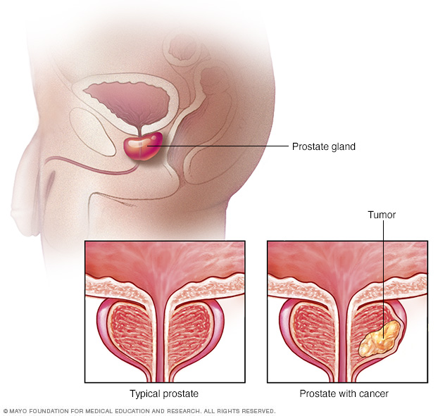 Årsaker og symptomer på prostatakreft