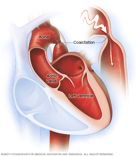 Coarctation Of The Aorta Disease Reference Guide