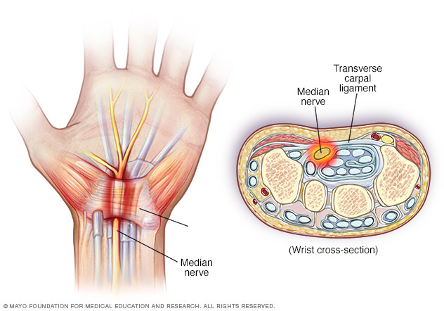 How to Treat Pinched Nerve Naturally?