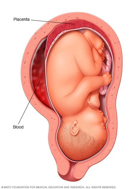 What Is The Meaning Of Placenta Accreta