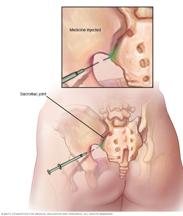 What Is The Treatment For Sacroiliac Joint Pain, Pain Management  Specialists & Anesthesiologists located in Greenbelt, MD