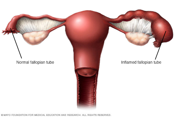 Pelvic Inflammatory Disease Pid Disease Reference Guide 5212