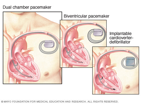 Pacemakere, hjertestarter