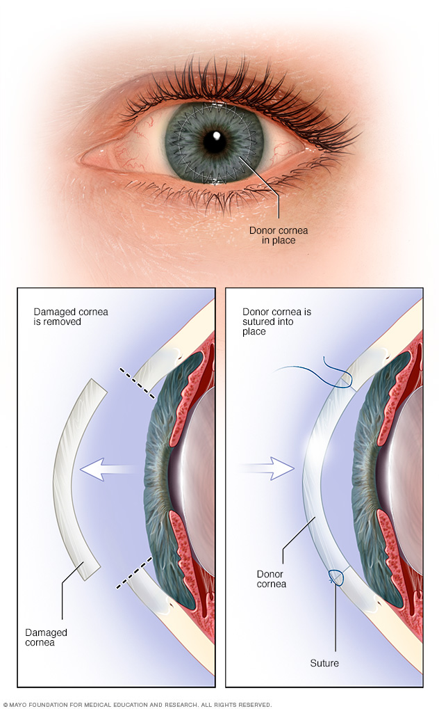 Кератопластика. Cornea. Cornea функция. Cornea перевод. Кератоконус у животного.