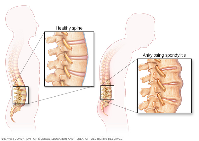 spondylitis pillow