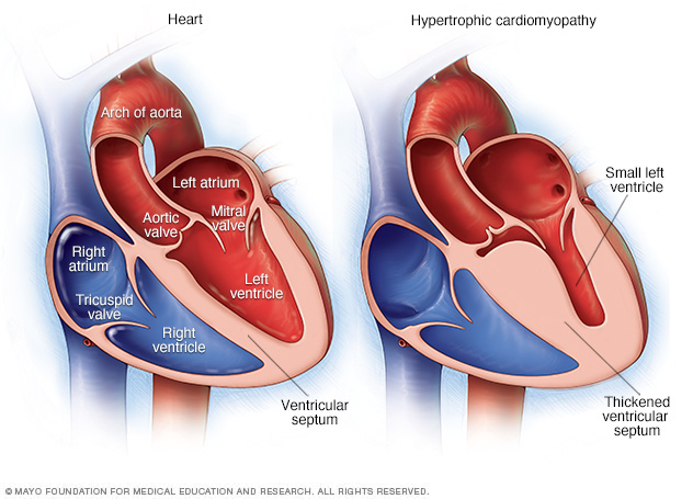 case study about cardiomyopathy