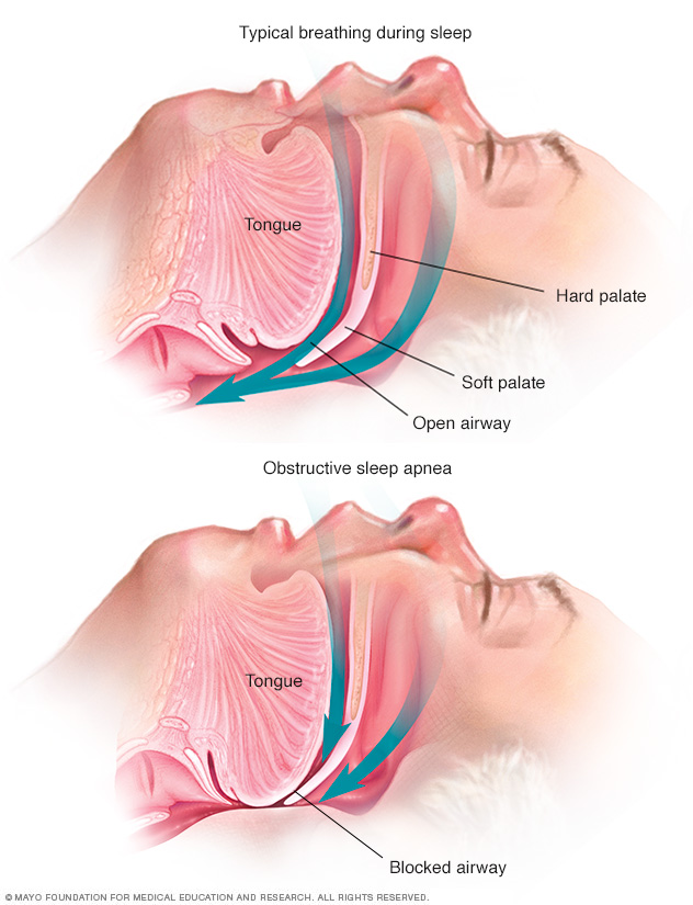 Sleep Apnea Disease Reference Guide Drugs