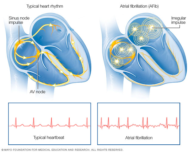 atrial flutter causes mayo clinic