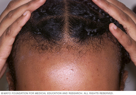 Trekkraft alopecia